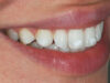 Почему на зубах появляются белые пятна и как их убрать