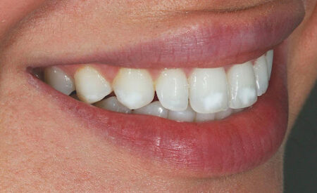 Почему на зубах появляются белые пятна и как их убрать